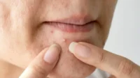 Tips Efektif Menghilangkan Jerawat Batu di Hidung dengan Aman dan Cepat Tips Efektif Menghilangkan Jerawat Batu di Hidung dengan Aman dan Cepat